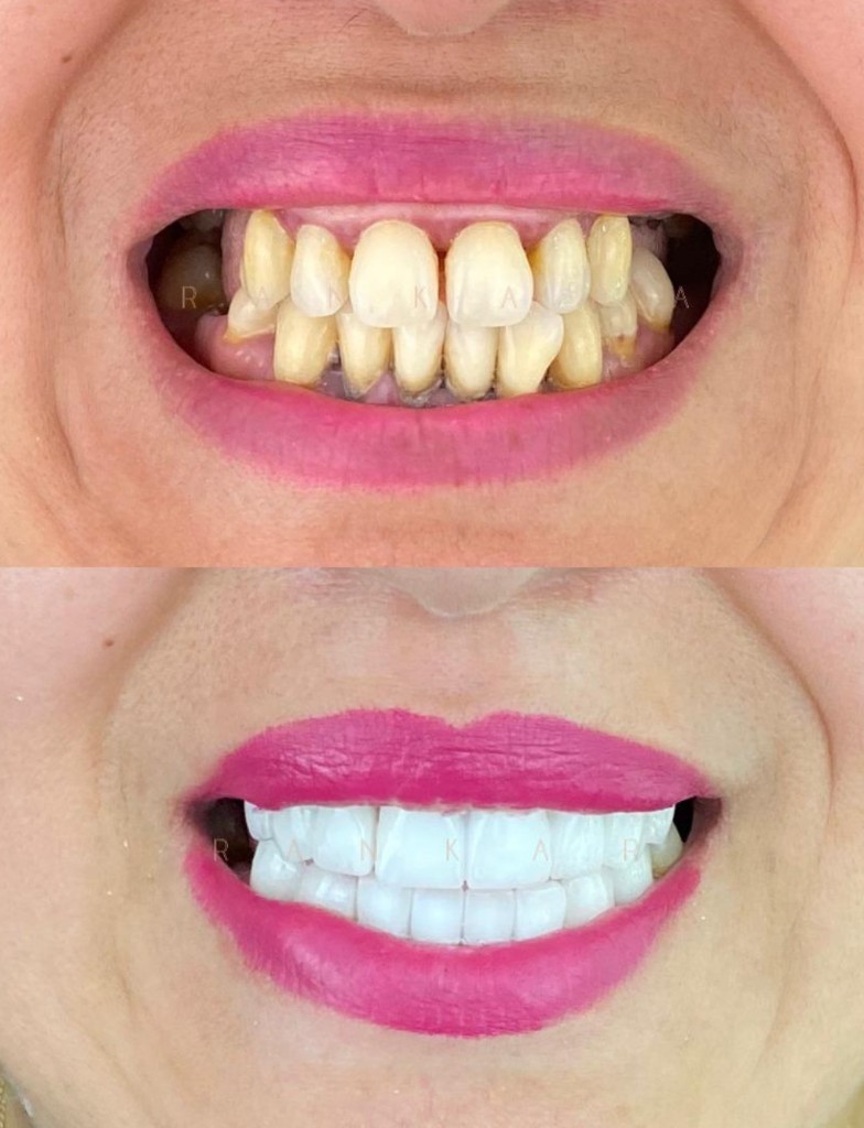 Dental implants