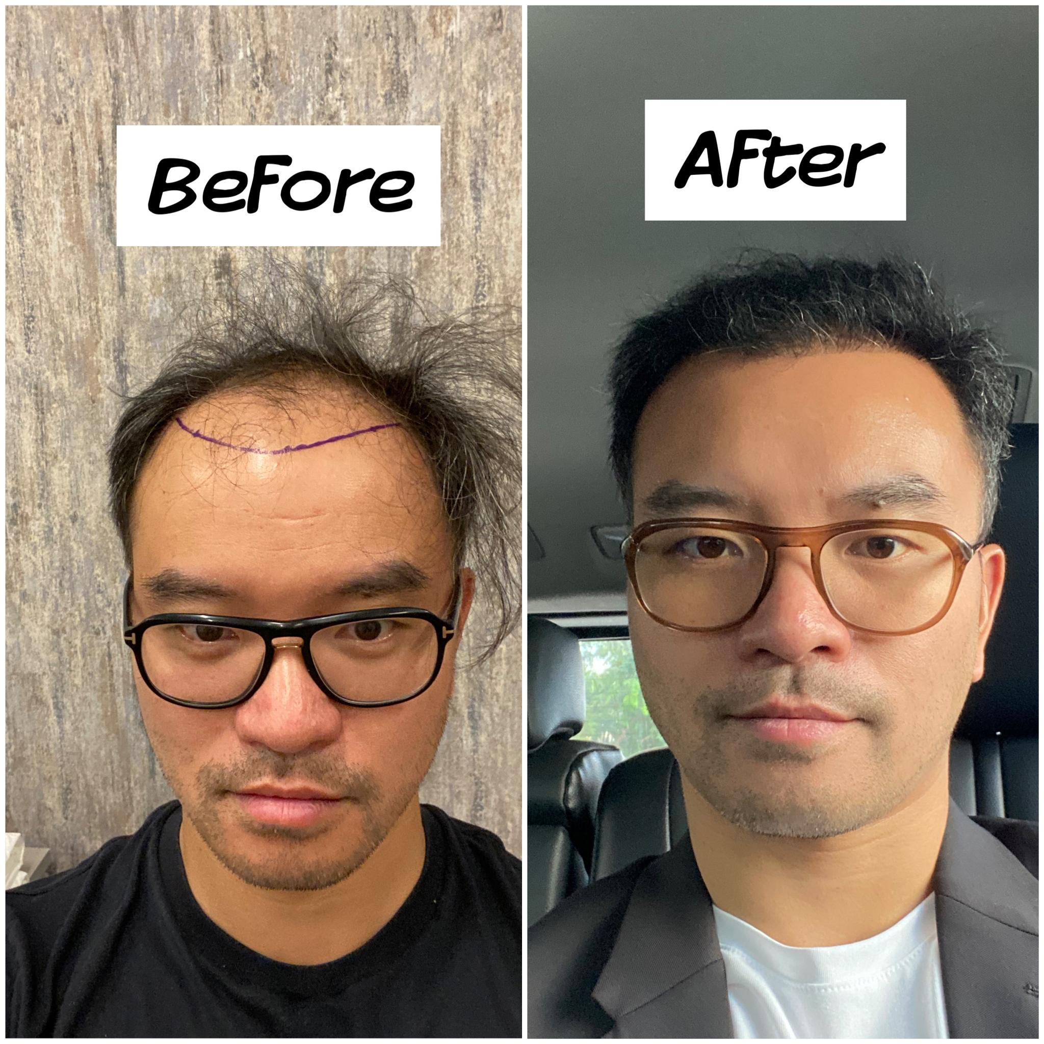 Hair Transplant