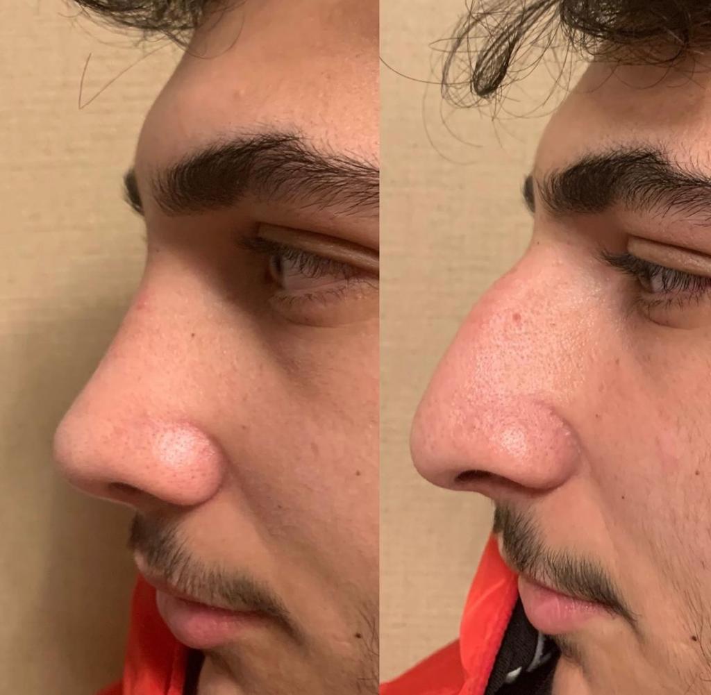 Rhinoplasty care path, Estefulya Global