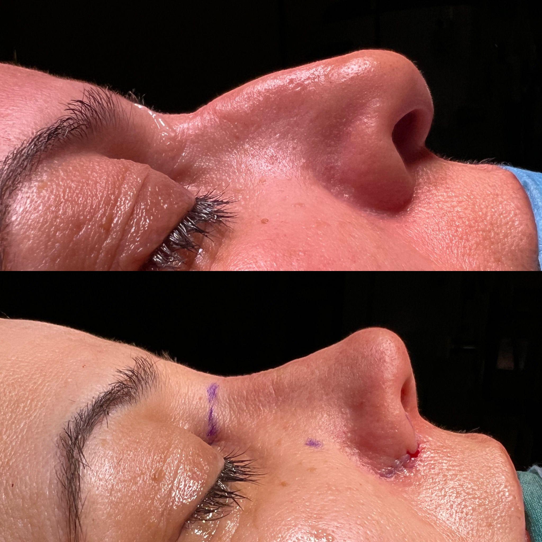 Rhinoplasty