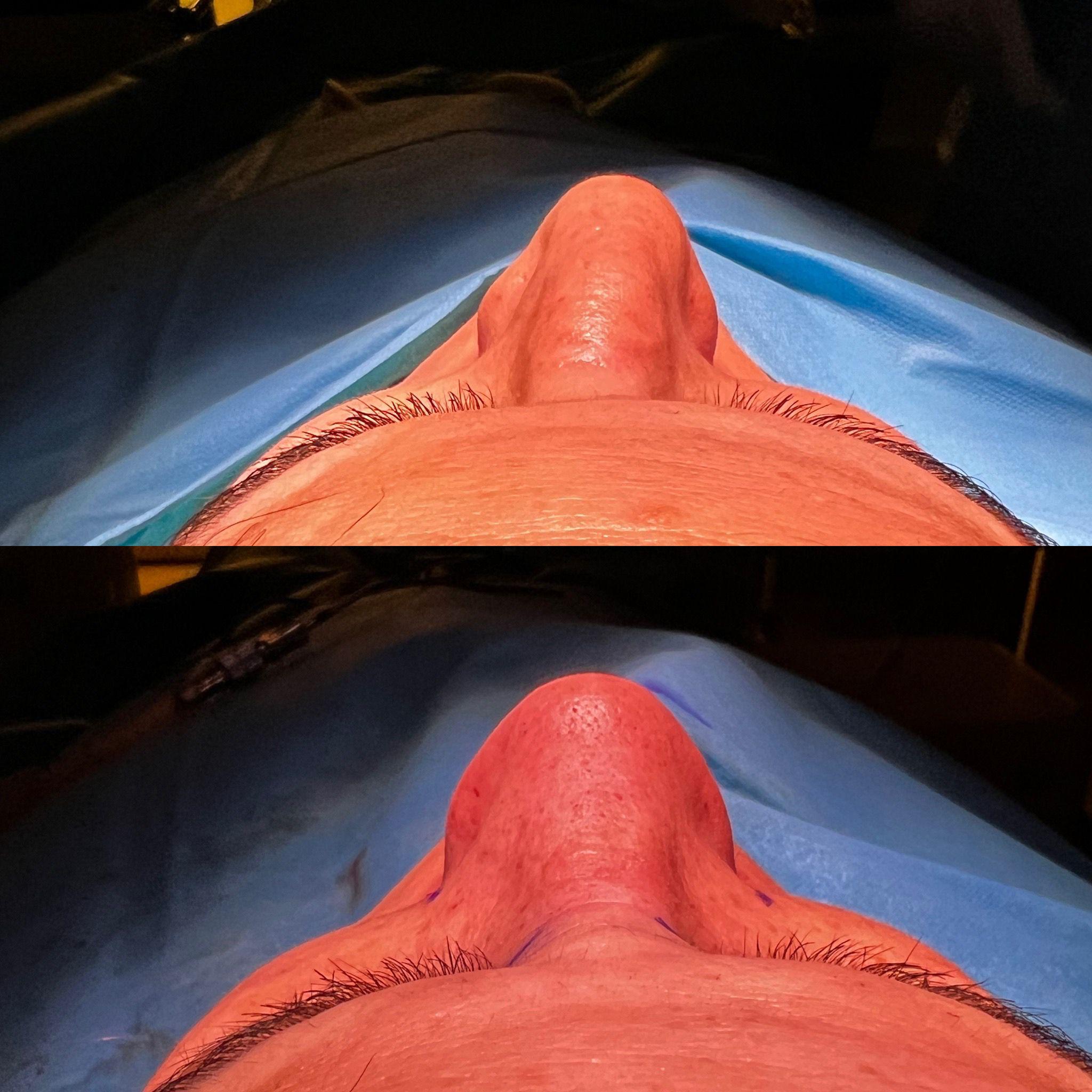Male rhinoplasty